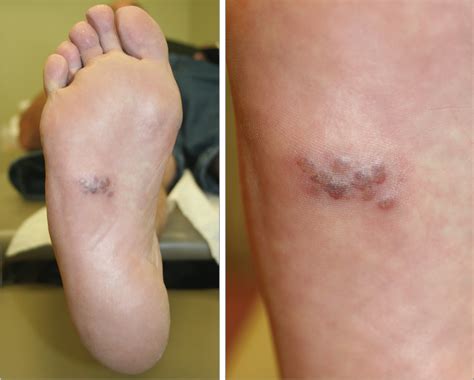 A 55-Year-Old Man With a Painful Rash on the Sole of His Foot | Pain Medicine | JAMA | JAMA Network