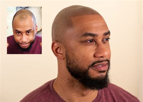 How long does scalp micropigmentation last? - Scalp Micro USA