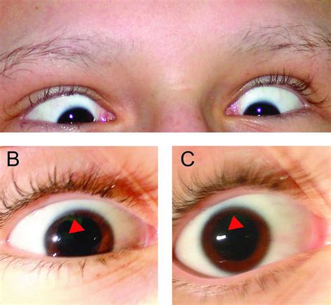 Parinaud syndrome causes, symptoms, diagnosis, treatment & prognosis