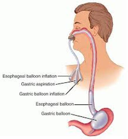 Sengstaken-Blakemore Tube Placement for Bleeding Esophageal Varices – Sinai EM