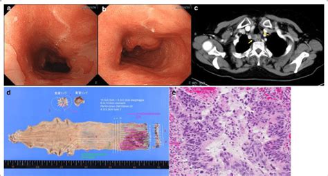 Endoscopy, computed tomography, and histopathological findings for case ...