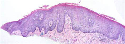 Labial Lentigo (labial melanotic macule) - Dermatology Advisor