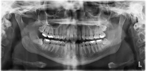 Dental x-rays | University of Michigan School of Dentistry