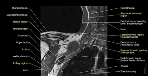 Brachial plexus MR: normal anatomy | e-Anatomy