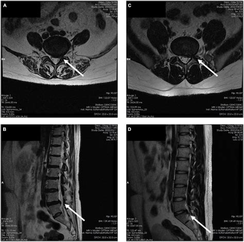 A diagnostic model of nerve root compression localization in lower ...