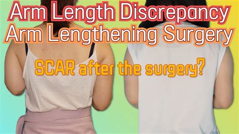 Arm Length Discrepancy Arm Lengthening Surgery - YouTube