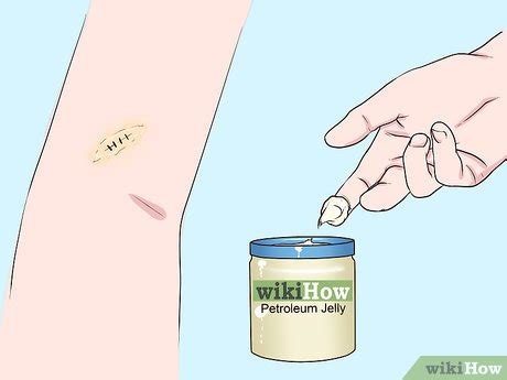 3 Ways to Undergo a Mole Biopsy - wikiHow Health