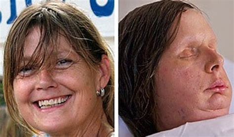 Charla Nash, face transplant recipient, to get $4M from estate of chimp ...