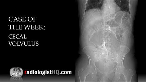 Sigmoid Volvulus Mri