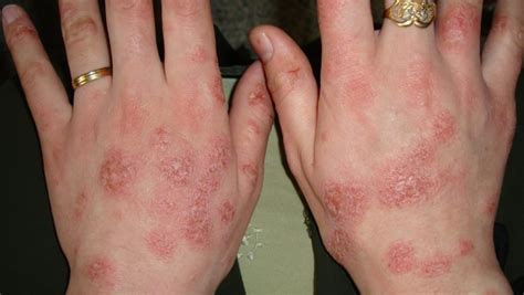 Eczema - Hand, Face, Baby, Causes, Symptoms & Treatment