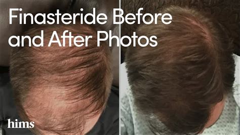 Finasteride Results: Finasteride Before and After Photos - YouTube