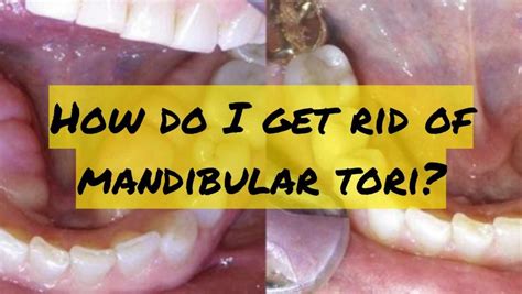 Understanding Mandibular Tori: Causes, Treatment, and Concerns