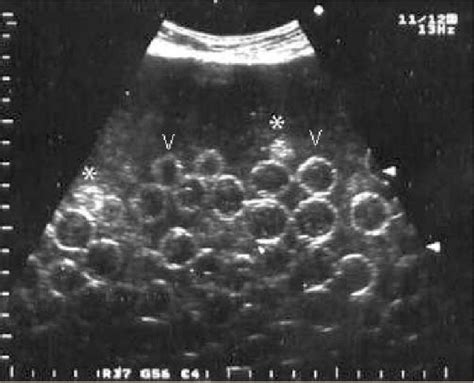 Daughter Cyst Ovary Ultrasound