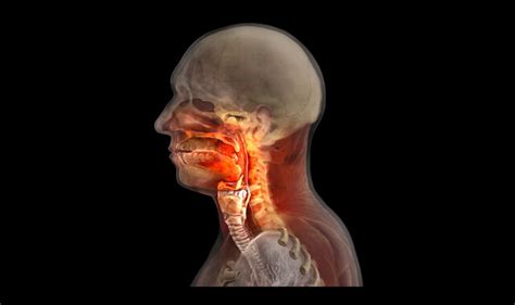 What Are the Signs and Symptoms of Laryngeal Cancer or Papillomatosis ...