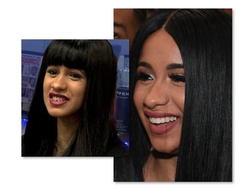 Cardi B Teeth Before And After Old Smile Vs New - Empire BBK