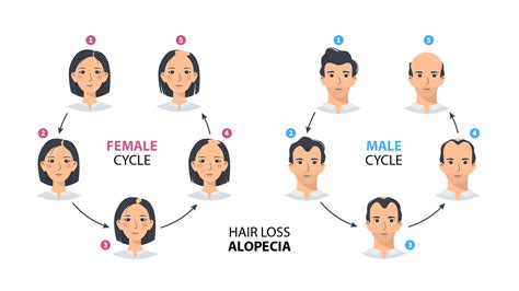 Androgenetic alopecia: all about this cause of baldness