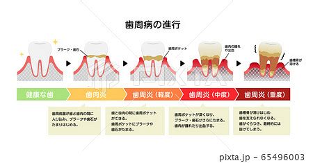 歯肉炎・歯周病のステージと症状イラストのイラスト素材 [65496003] - PIXTA