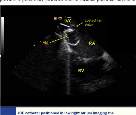 Figure 3 from The Evolving Utility Of Intracardiac Echocardiography In Cardiac Procedures ...