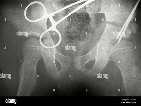 An x-ray showing coxa magna, enlargement and deformation of the head of ...