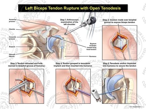 Left Biceps Rupture with Open Tenodesis