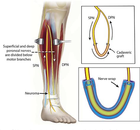 Figure 4 from Superficial Peroneal Nerve to Deep Peroneal Nerve ...