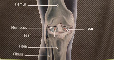 KNEE LIGAMENT INJURY | Klinique Pain Management & Wellbeing Clinic