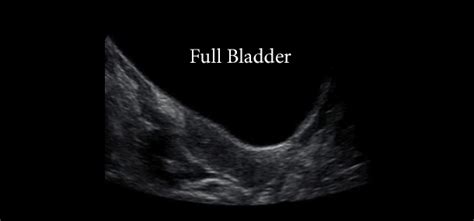 Ultrasounds and Bladders: What's the Connection? - Cincinnati Children ...