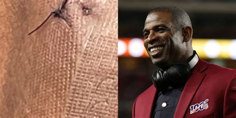 Deion Sanders Shares Gruesome Photo Of His Foot After Surgery (PIC)