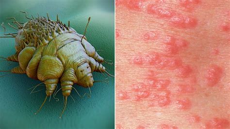 Scabies: Causes, Symptoms, Pictures of Rash, and Treatment | Everyday Health