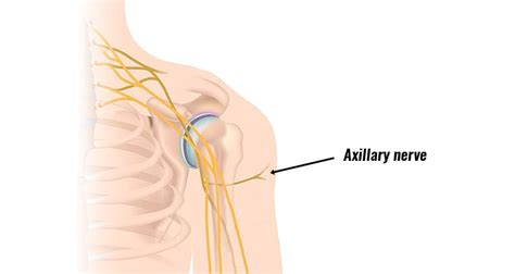 Axillary Nerve Injury - Symptoms, Causes and Treatment