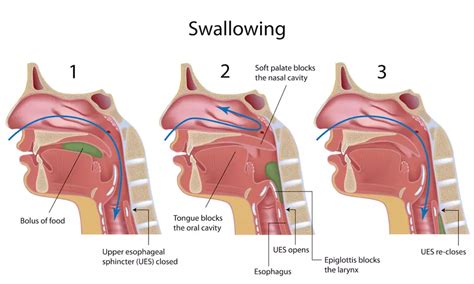 Nasal Regurgitation With Spinal Muscular Atrophy | mySMAteam