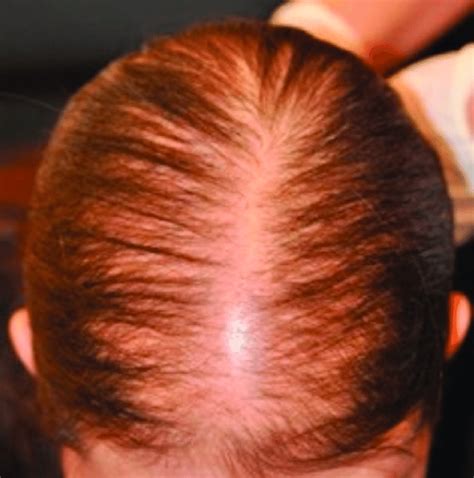 Patterned hair loss in a female patient. Alopecia resembles a... | Download Scientific Diagram