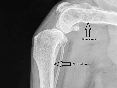 Symptoms Of Bone Cancer In Shoulder - Bone Tumor: Types, Causes, and Symptoms : Bone cancer can ...