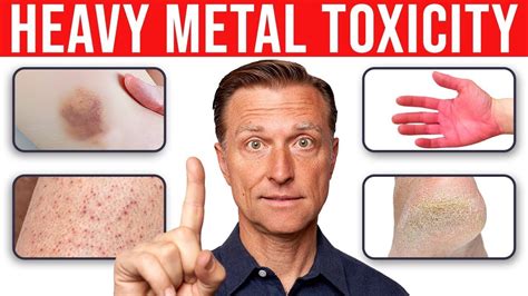 Identifying Heavy Metal Toxicity From Your Skin