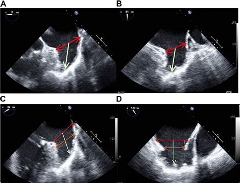 Percutaneous Left Atrial Appendage Closure