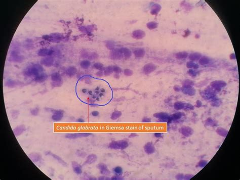 Candida glabrata in Giemsa stain of sputum: Introduction, Pathogenecity
