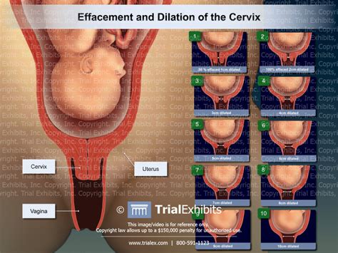 Effacement and Dilation of the Cervix - TrialQuest Inc.