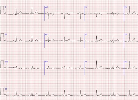 Normal Sinus Rhythm SVG