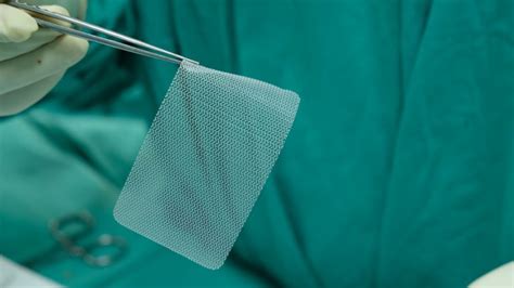 Can Hernia Mesh be Removed? | Is Mesh Removal Dangerous?