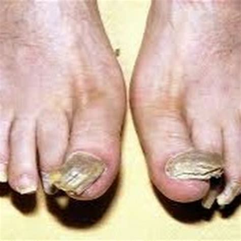 Treat Toenail Fungus - YouTube