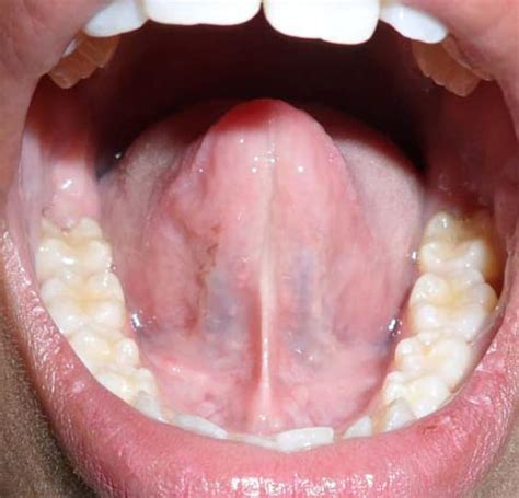 Tongue Tie (Ankyloglossia): Diagnosis, Symptoms, Surgery, and More ...