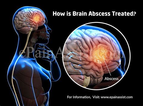 How is Brain Abscess Treated?