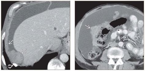 Abdominal Mesothelioma | Radiology Key