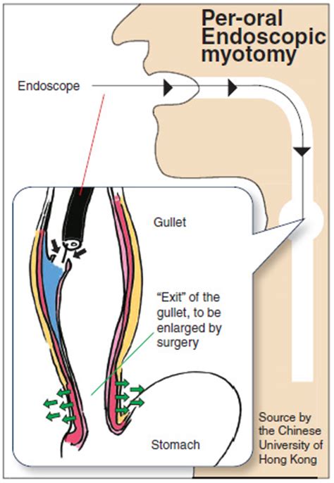 Non-invasive treatment to ease pain in gullet surgery