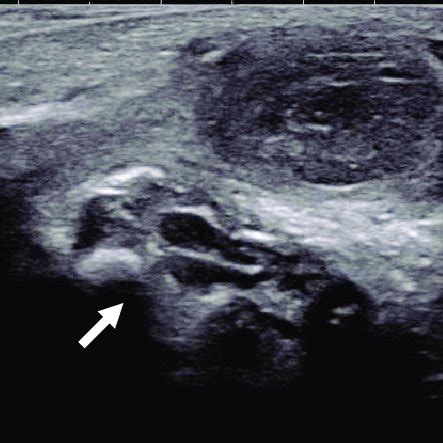 (PDF) Scrotal pyocele secondary to gastrointestinal perforation in ...