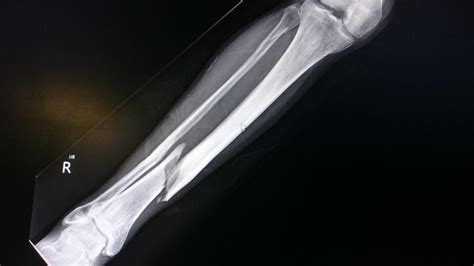 Tibia and Fibula Fractures - JOI Jacksonville Orthopaedic Institute