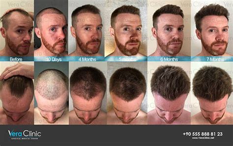 How Fast Does Hair Grow After Hair Transplant With Pictures - Vera Clinic