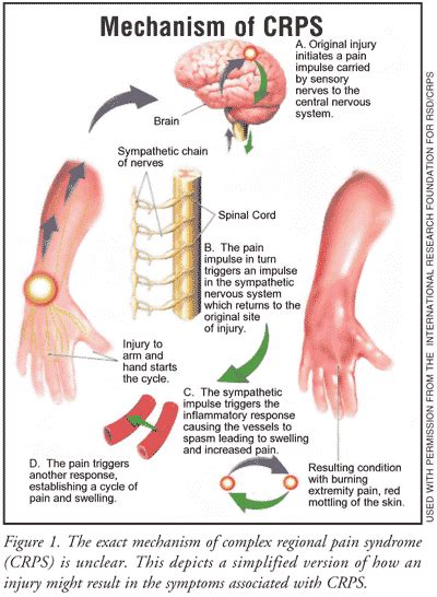 CRPS Guest Blog: Complex Regional Pain Syndrome - Capital Area PT ...