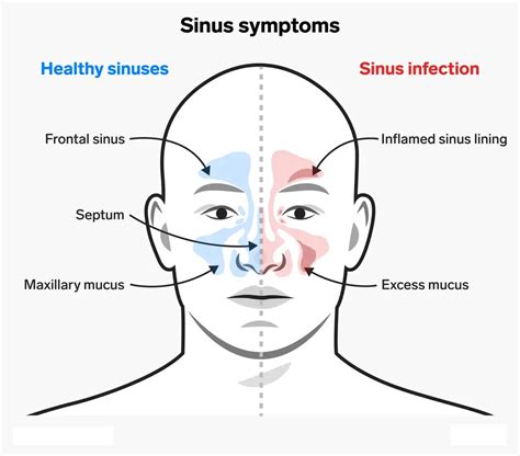 What Causes Swollen Nasal Passages