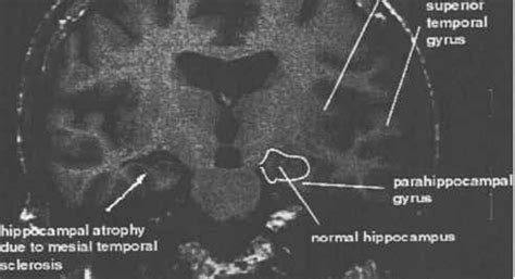 Mesial Temporal Lobe Seizures - Epileptic Seizures - 78 Steps Health